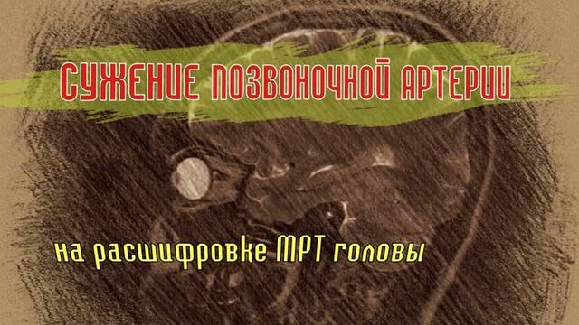 ГИПОПЛАЗИЯ позвоночной артерии (СУЖЕНИЕ правой ПА) на РАСШИФРОВКЕ МРТ мозга (второе мнение МРТ)